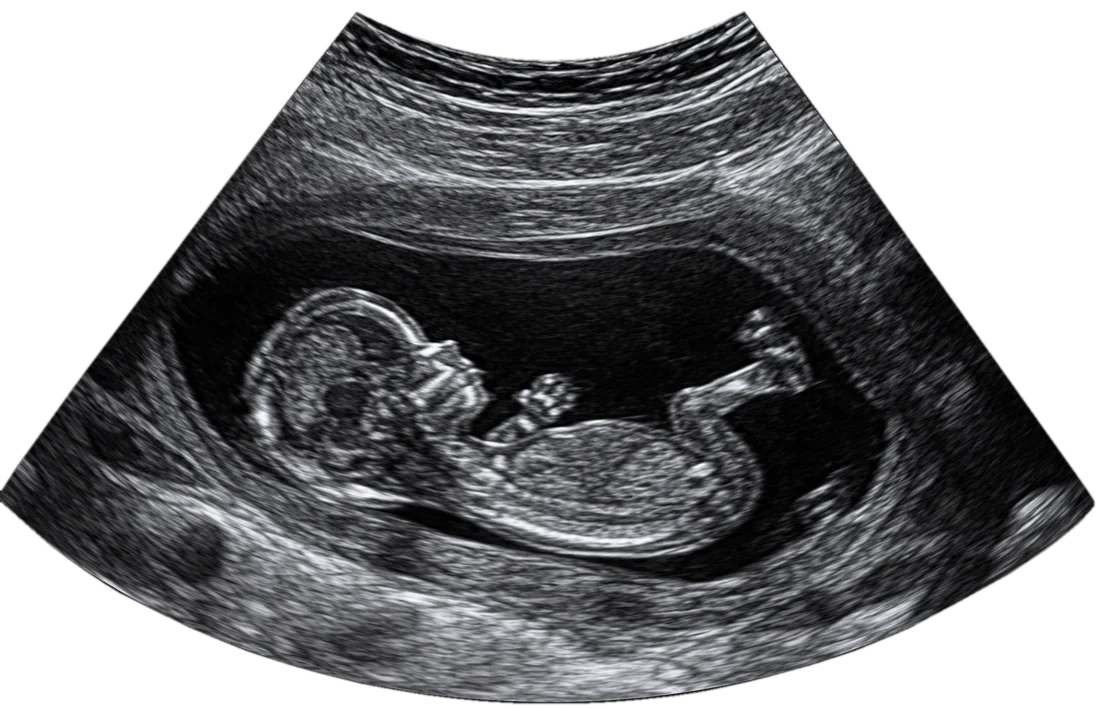 Ultrassom de um bebê de perfil no começo da gestação (imagem ilustrativa)