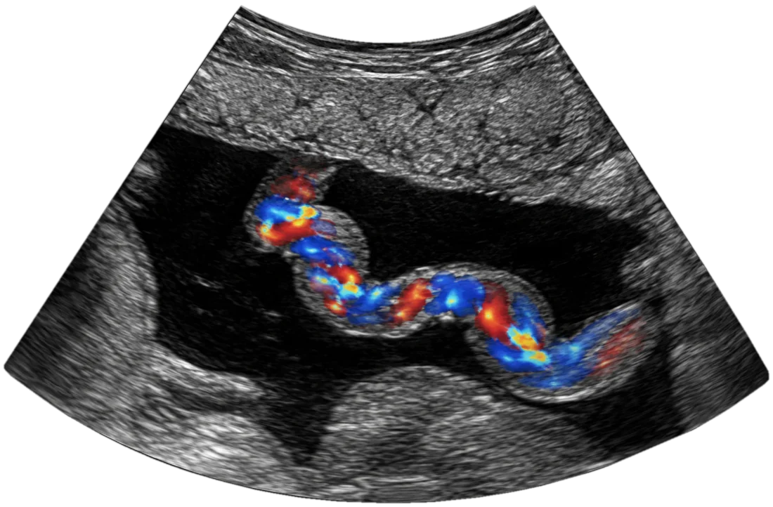 Doppler colorido mostrando o cordão umbilical (imagem ilustrativa)